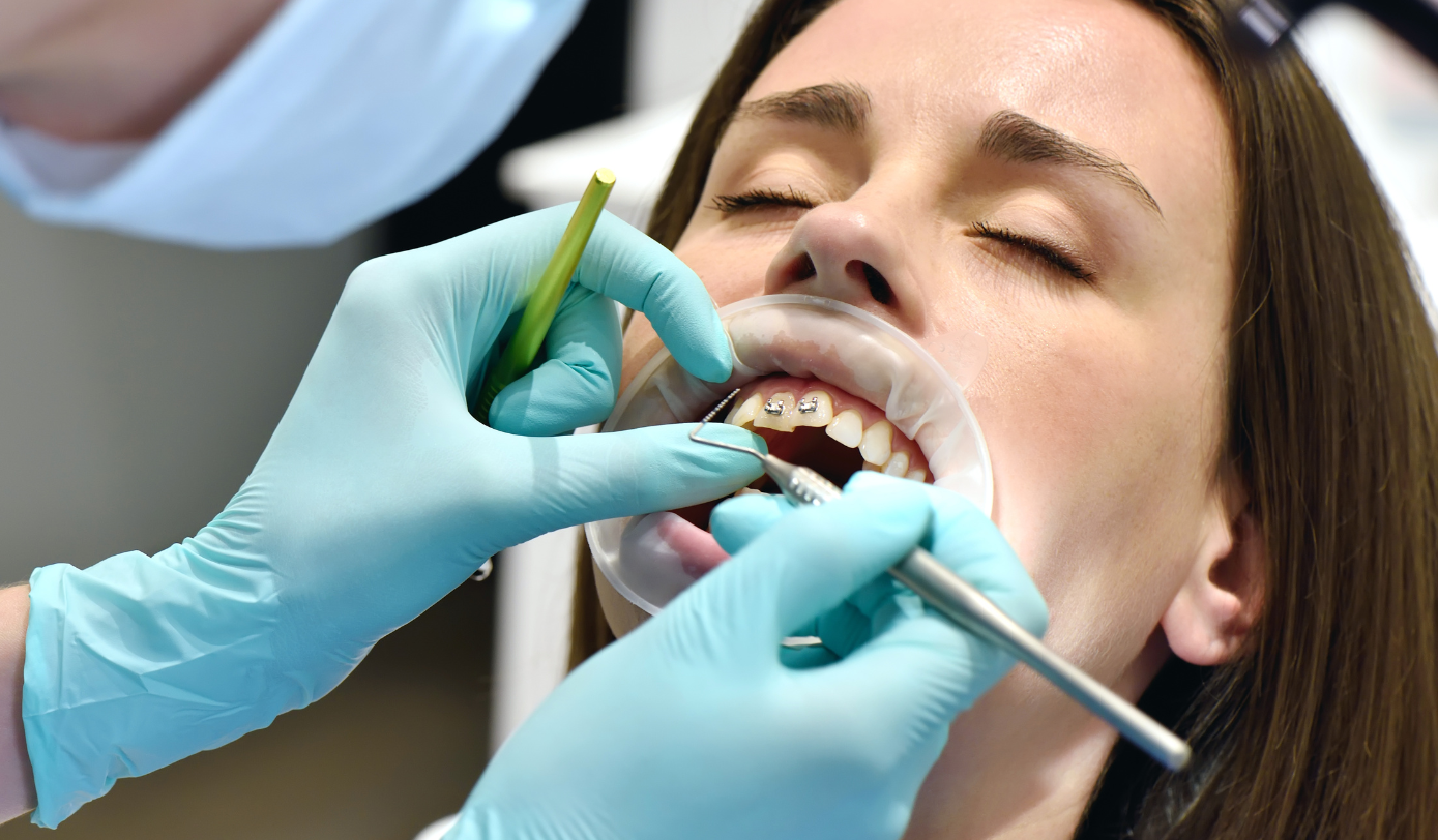 Dental Filling Service