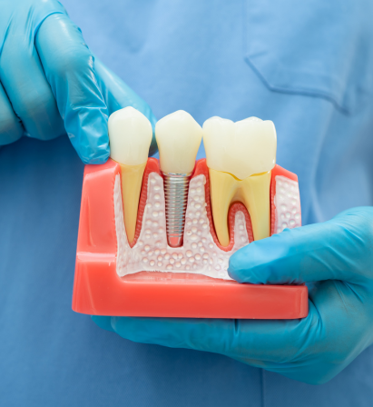 Root canal treatment